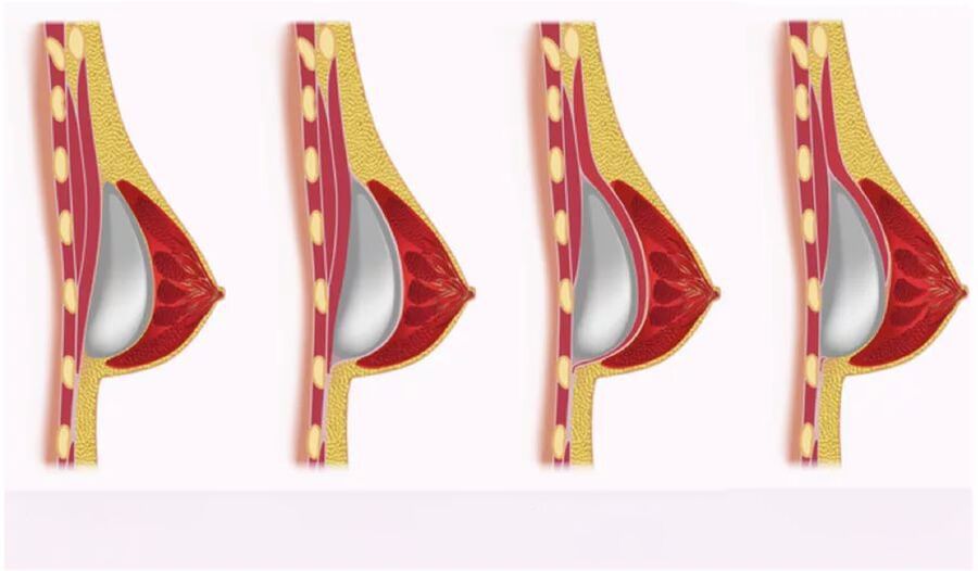 hozzáférés az implantátum beszereléséhez